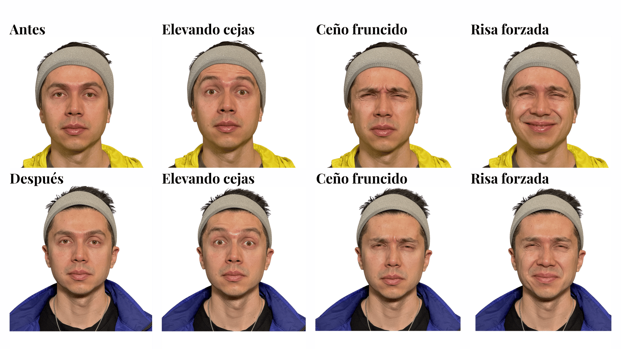 Antes y despues Toxina + Bioestimulación