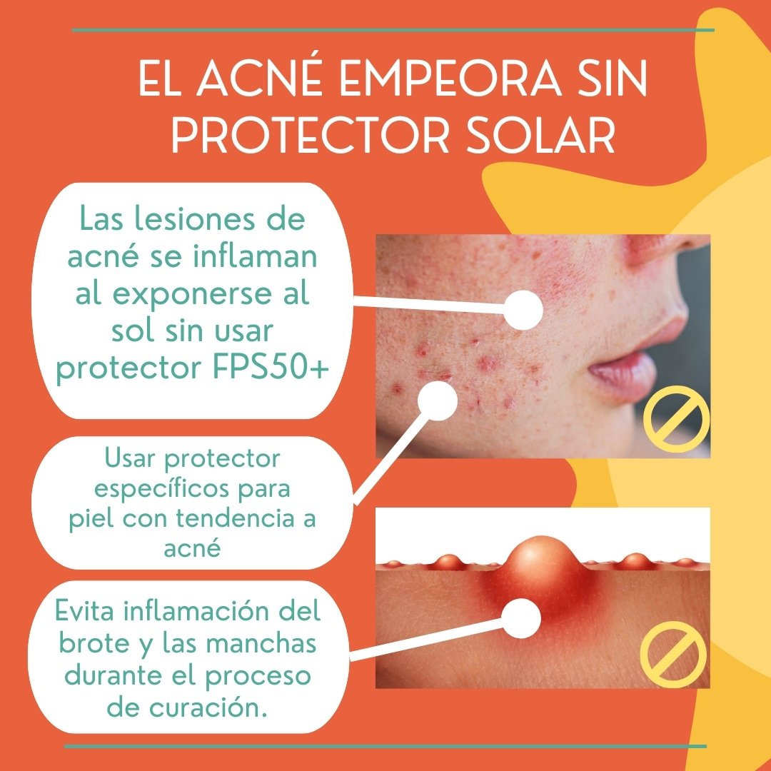 Cuidando la piel con protección solar .1 Acné empeora