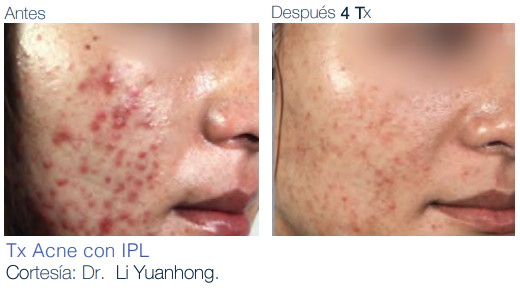 correccion-con-laser-ipl-remover-manchas-acne
