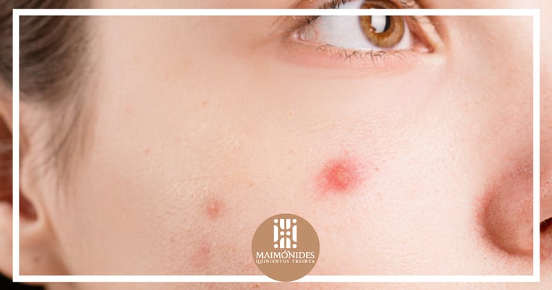 prevencion-y-cuidados-contra-el-acne