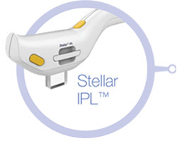 laser-stellar-m22-IPL